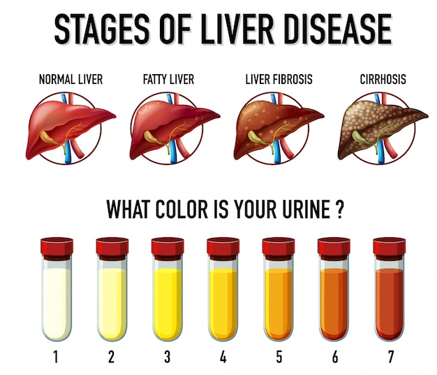 Free vector stages of liver disease