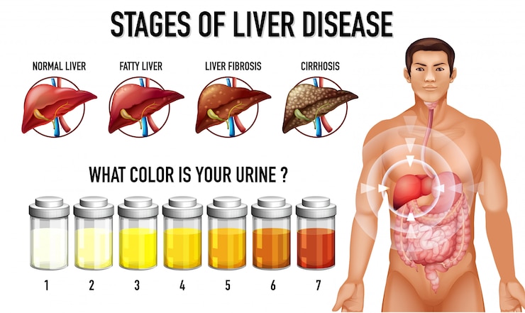 Free Vector stages of liver disease