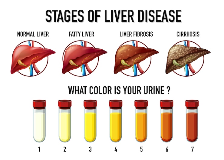 Free Vector stages of liver disease