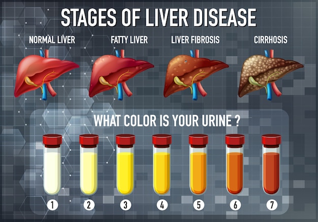 Free vector stages of liver disease
