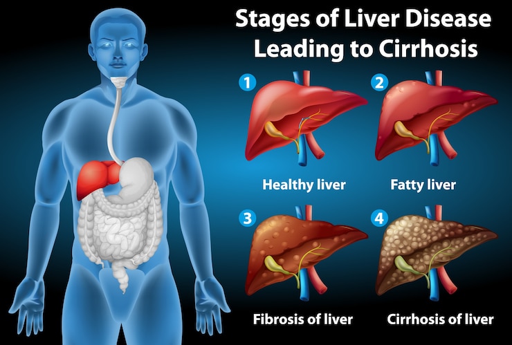 Free Vector stages of liver disease