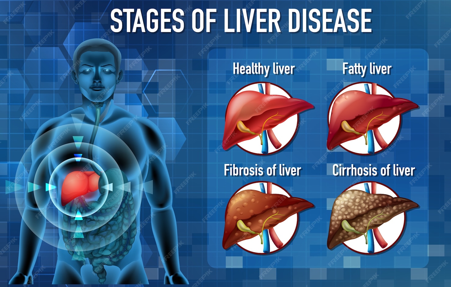 Free Vector Stages Of Liver Disease