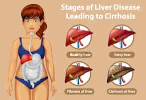 Бесплатное векторное изображение Стадии заболевания печени, приводящей к циррозу