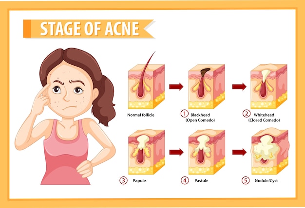 Stages of skin acne anatomy with a woman doing stressful pose