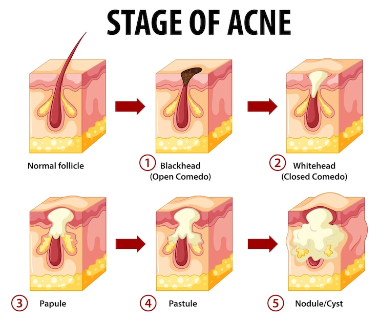 Free Vector stages of skin acne anatomy