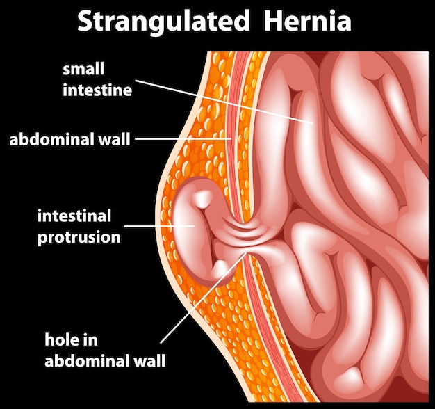 Free vector strangulated hernia diagram for education