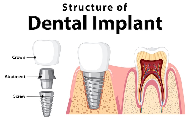 Struttura dell'impianto dentale su sfondo bianco