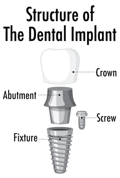 Free vector structure of the dental implant on white background