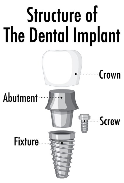 Структура зубного имплантата на белом фоне