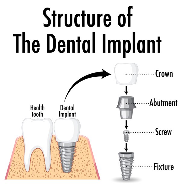 Structure of the dental implant on white background