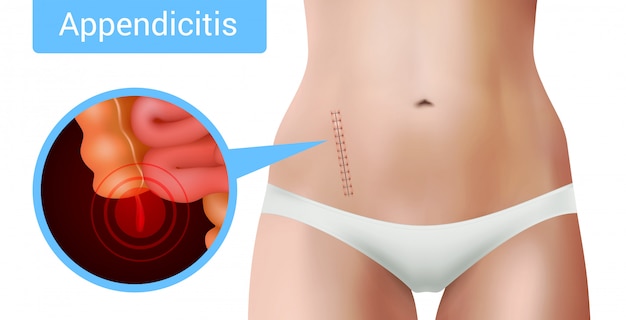 Surgical suture stitches realistic appendicitis composition with view of surgical intervention mark on realistic female body