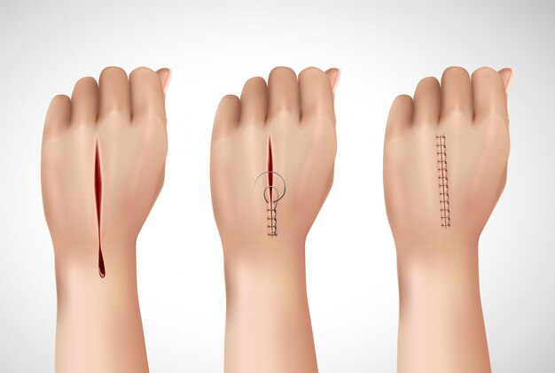 手術用縫合糸は、ステッチングのさまざまな段階で人間の手の孤立した画像で現実的な構成をステッチします