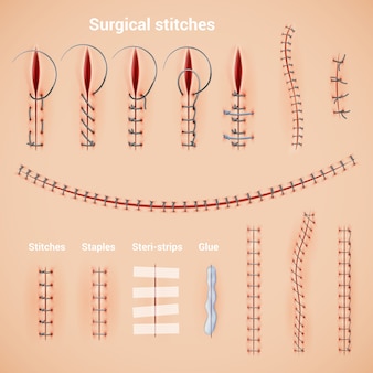 外科用縫合糸は、ステープル接着剤とテキストキャプションを使用して、現実的な一連のステッチ方法と形状をステッチします 無料ベクター
