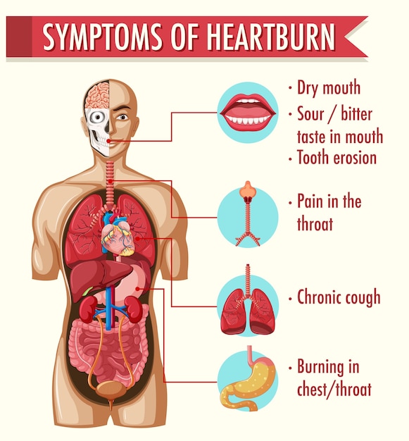 Free vector symptoms of heartburn information infographic