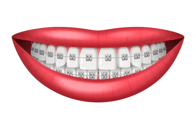 無料ベクター 歯歯科ブレース現実的な白い背景のベクトル図に分離