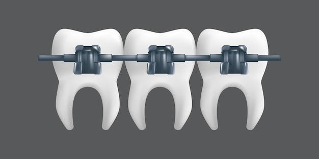 金属ブレース付きの歯。矯正治療のコンセプト。灰色の背景に分離された歯科用セラミックモデルのリアルなイラスト Premiumベクター