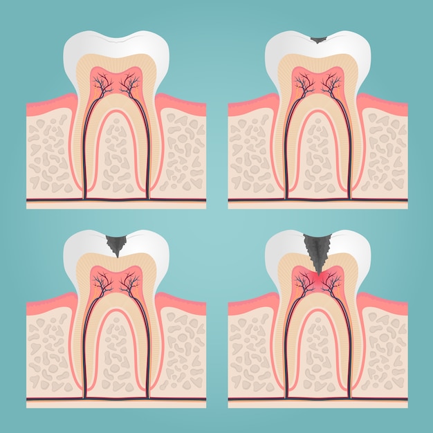 Free vector tooth anatomy and damage, cut teeth in the gums vector illustration