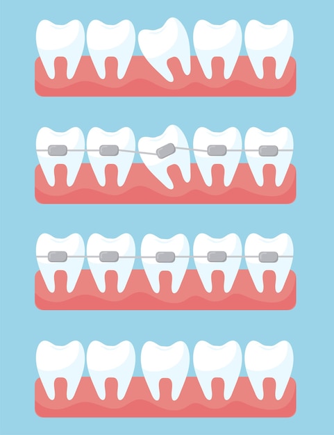 Зуб с комплектом ортодонтических скоб