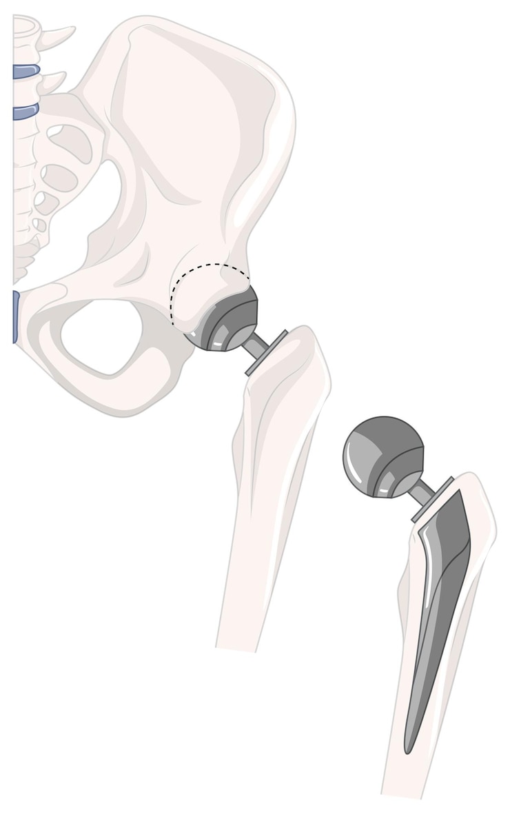 Free Vector treatment of human hip bone