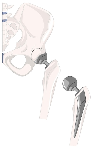 Treatment of human hip bone