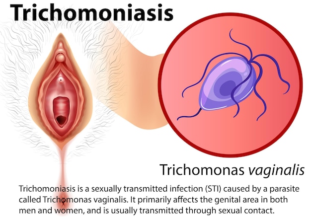 Free vector trichomoniasis infographic with explanation