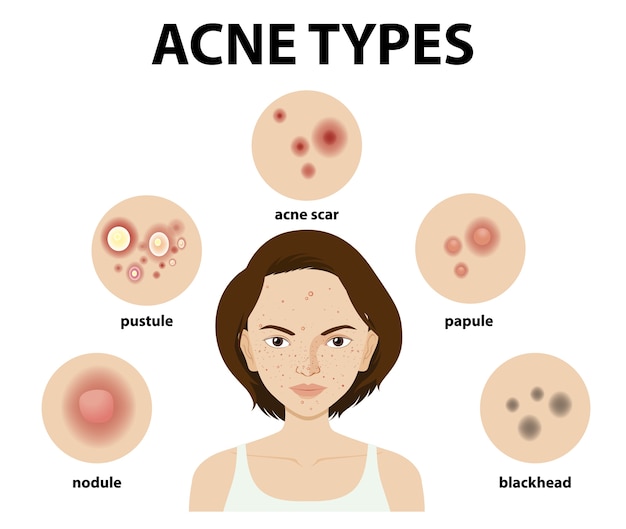 Vettore gratuito tipi di acne sulla pelle o brufoli