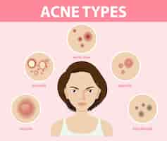 Free vector types of acne on the skin or pimples