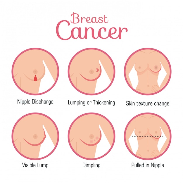 Free vector types of appearances of the breast