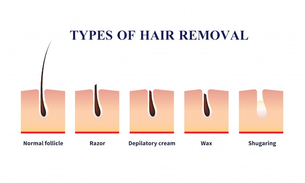 Free vector types of hair removal illustration