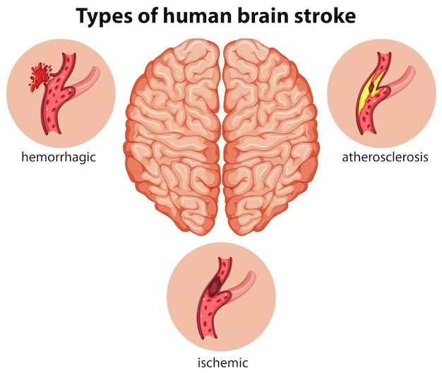 Vettore gratuito tipi di ictus cerebrale umano