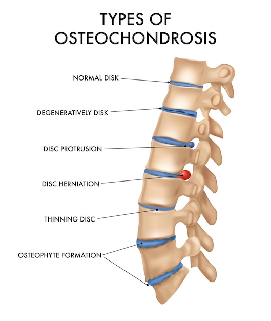 Types of osteochondrosis with spinal column