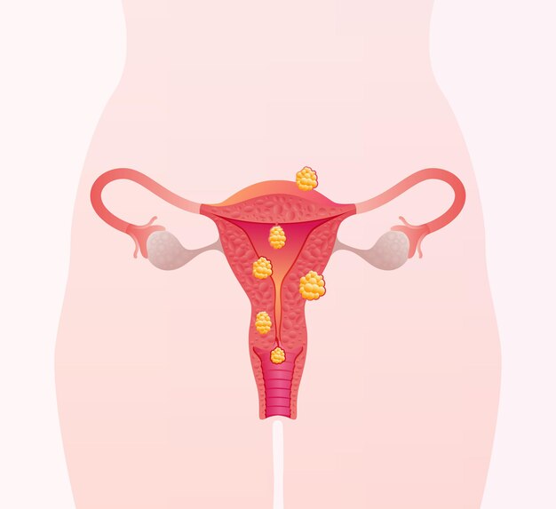 Types of uterine fibroids female reproductive system diseases