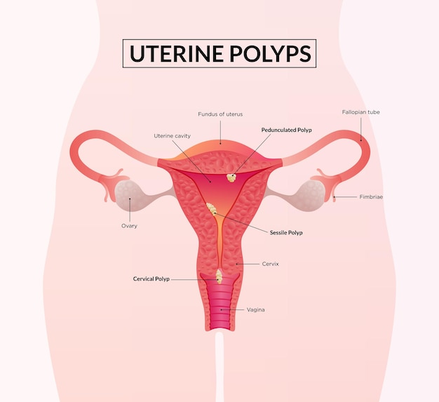 Types of uterine polyp female reproductive system diseases