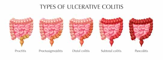 Free vector ulcerative colitis types infographics