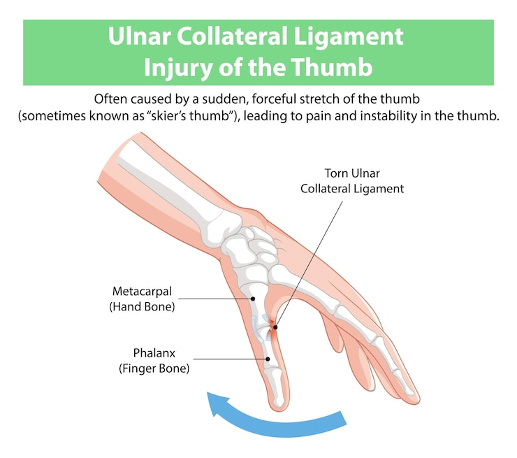 मुफ़्त वेक्टर ulnar collateral ligament injury illustration