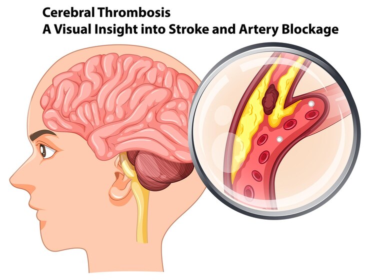 Free Vector understanding cerebral thrombosis and stroke