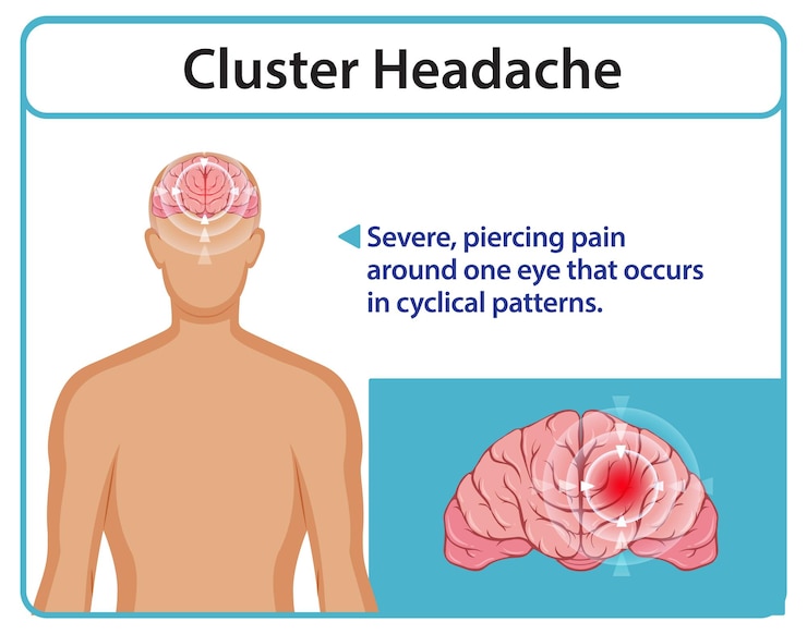 Free Vector understanding cluster headaches and symptoms