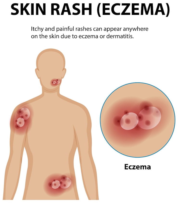 Free Vector understanding eczema and skin rashes