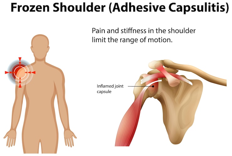 मुफ़्त वेक्टर understanding frozen shoulder anatomy