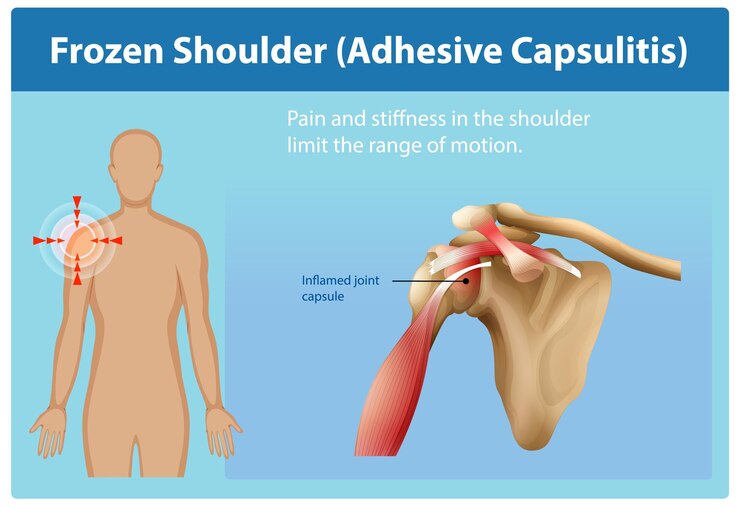 Free Vector understanding frozen shoulder pain relief