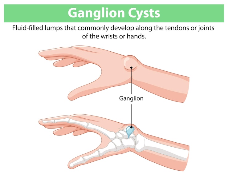 Free Vector understanding ganglion cysts in hands