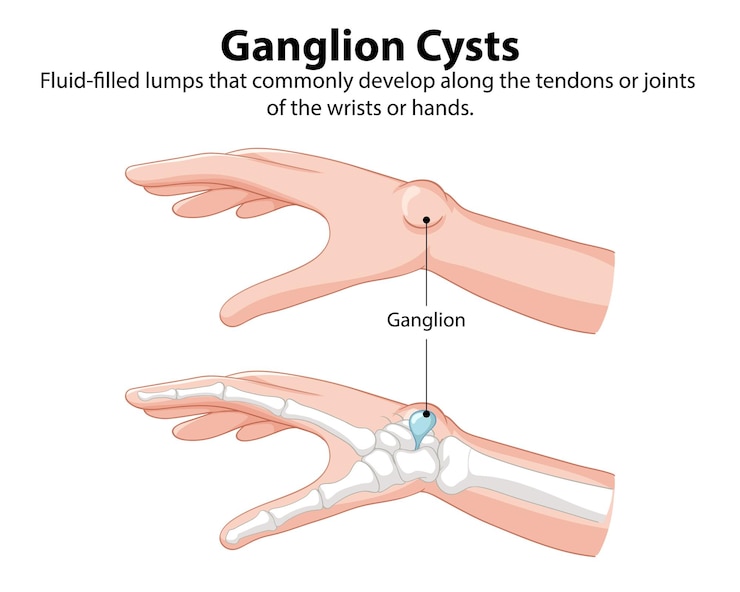 मुफ़्त वेक्टर understanding ganglion cysts in hands