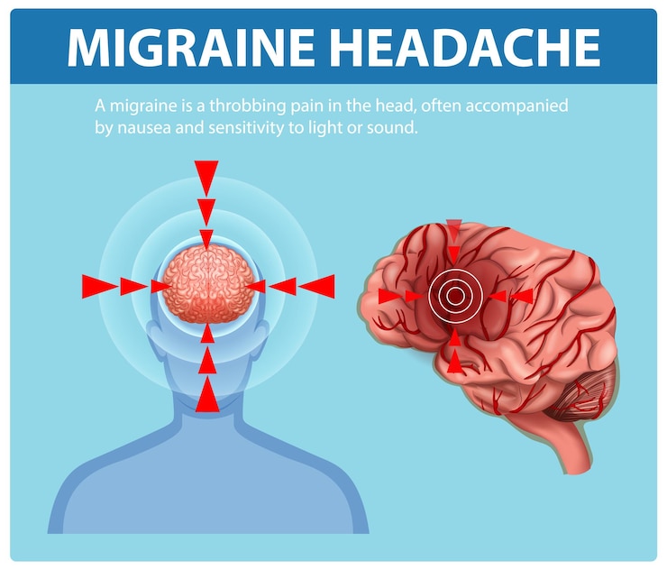 Free Vector understanding migraine headache symptoms