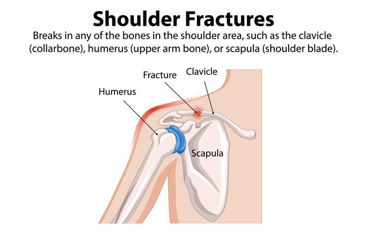 Free Vector understanding shoulder fractures