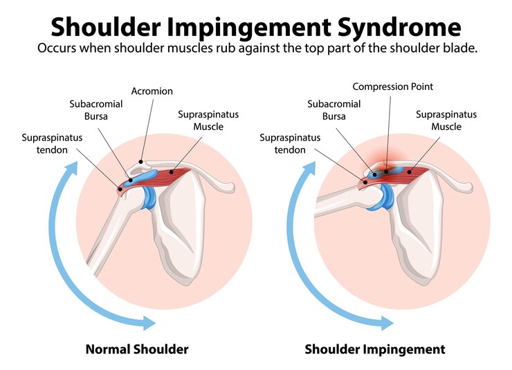 Free Vector understanding shoulder impingement syndrome