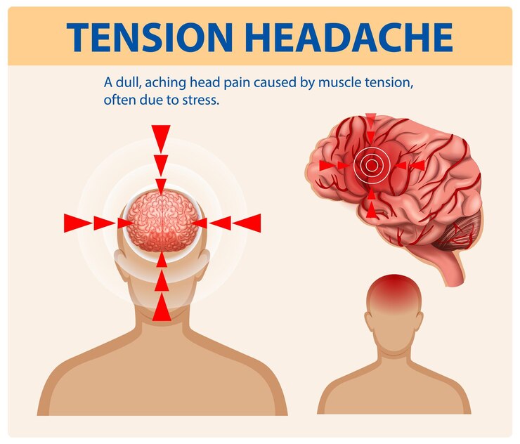 Free Vector understanding tension headaches and their causes