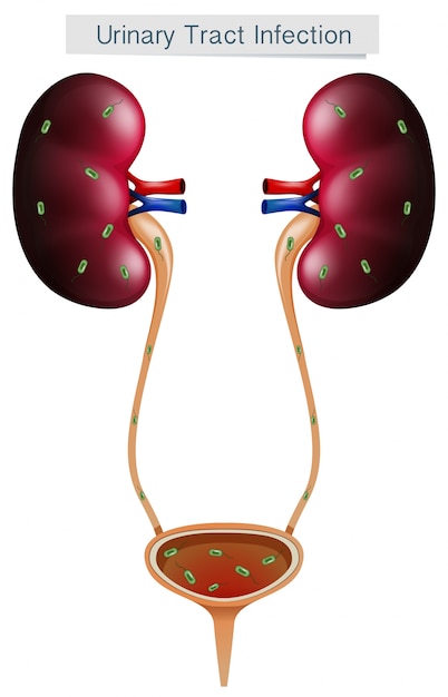 無料ベクター 白い背景の尿路感染症