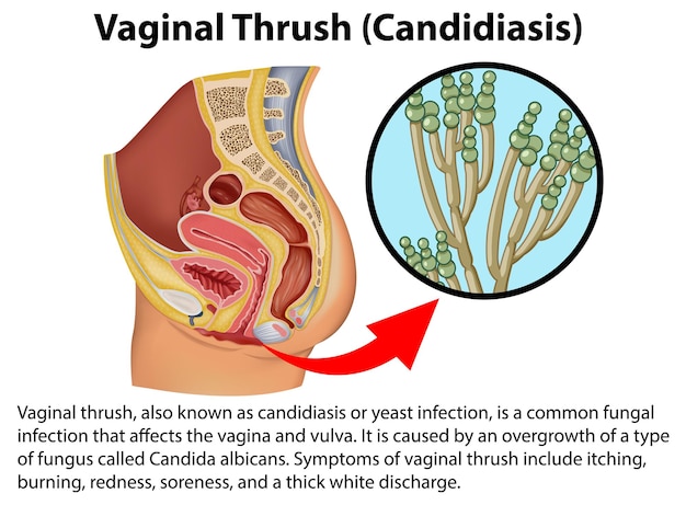 Free vector vaginal thrush candidiasis infographic with explanation