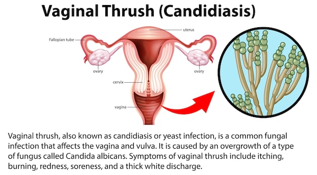 Free vector vaginal thrush candidiasis infographic with explanation
