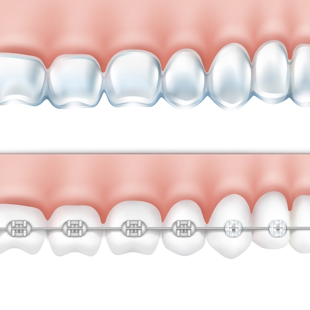 Бесплатное векторное изображение Вектор человеческие зубы с металлическими брекетами и отбеливающий лоток, вид сбоку, изолированные на белом фоне